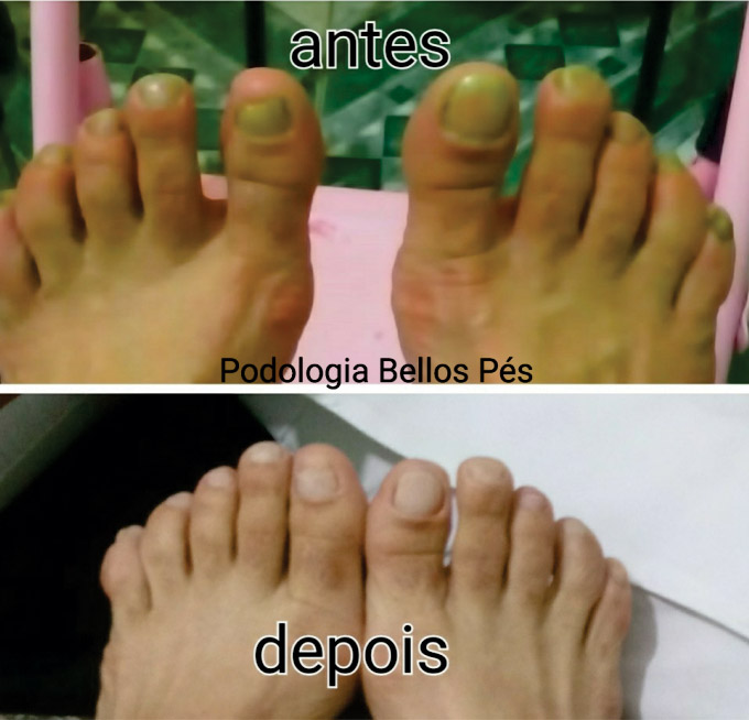 Podologia Saúde dos Pés