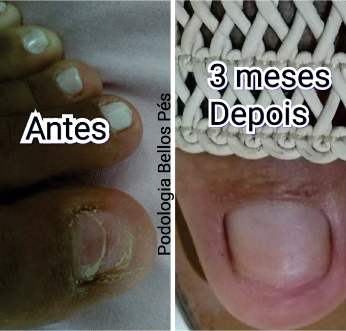 Podologia Saúde dos Pés