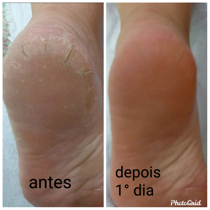 Podologia Saúde dos Pés
