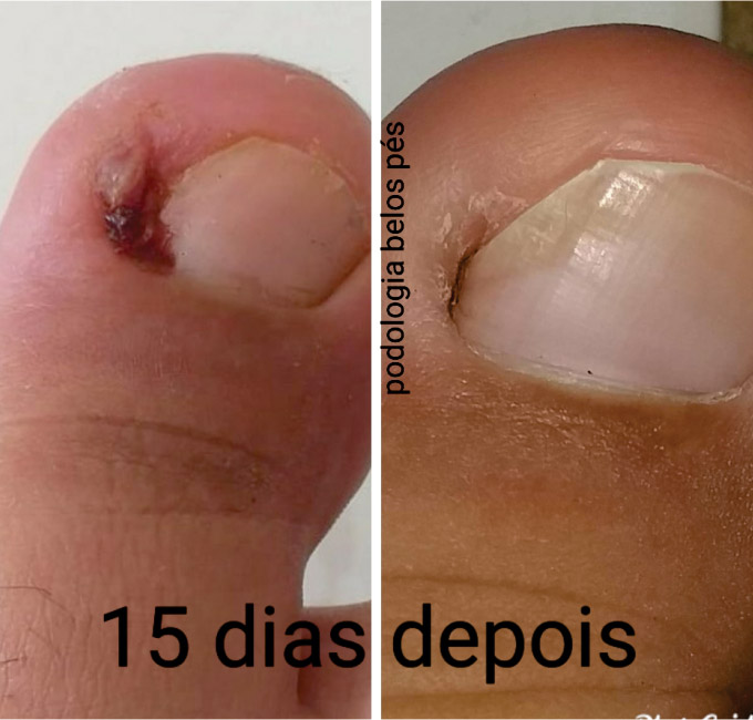 Podologia Saúde dos Pés